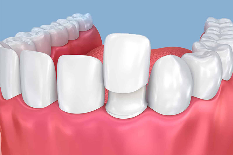 Răng tạm khi làm răng sứ