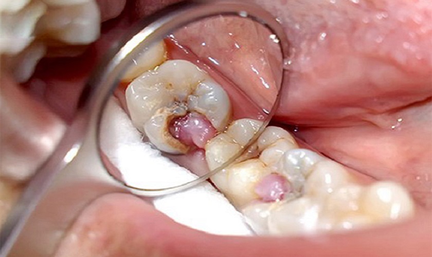 Chưa điều trị triệt để bệnh lý viêm tủy dẫn đến răng bọc sứ bị viêm tuỷ
