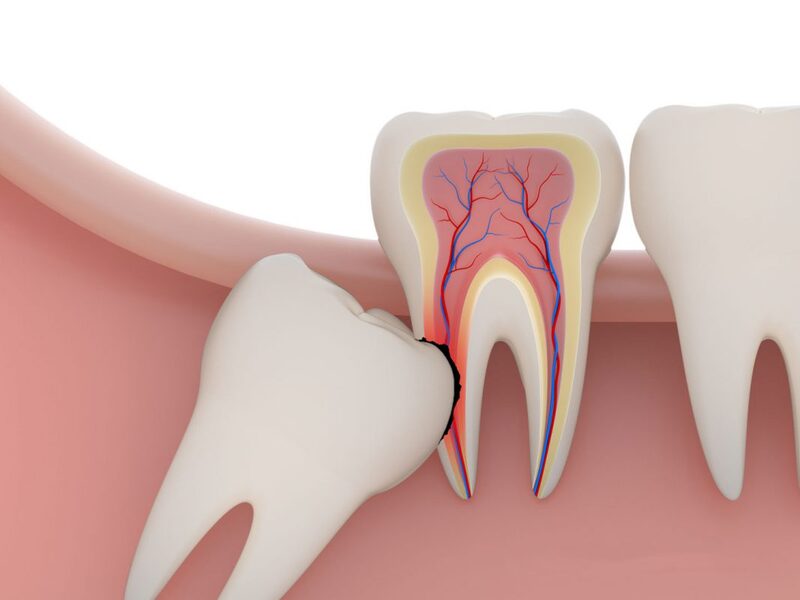 Răng khôn mọc ở đâu? Những sự thật thú vị về răng khôn