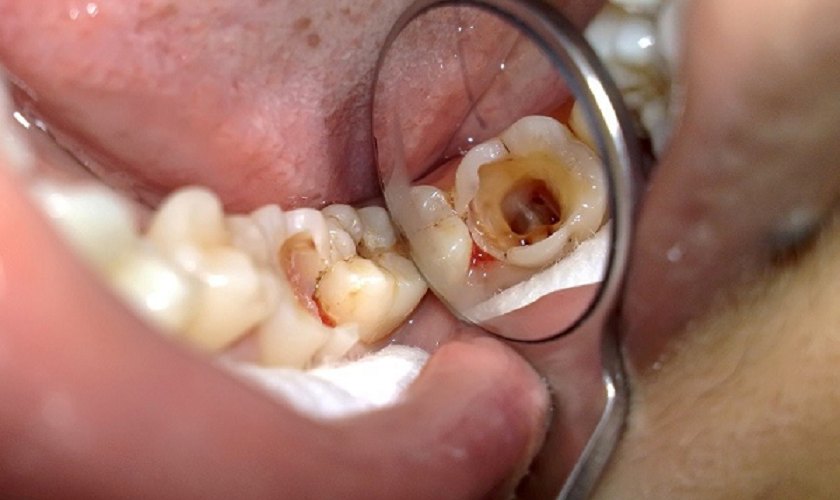 Khi răng số 7 bị sâu vỡ có nguy hiểm không?