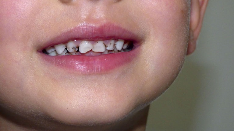 Top 10 thuốc trị sâu răng cho bé an toàn, lành tính