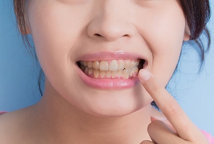 Các loại kháng sinh răng miệng phổ biến hiện nay