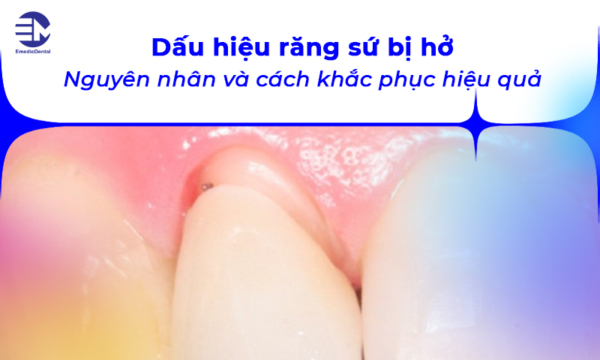 Dấu hiệu răng sứ bị hở: Nguyên nhân và cách khắc phục