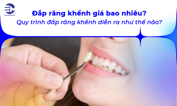 Đắp răng khểnh giá bao nhiêu? Quy trình đắp răng khểnh diễn ra như thế nào?