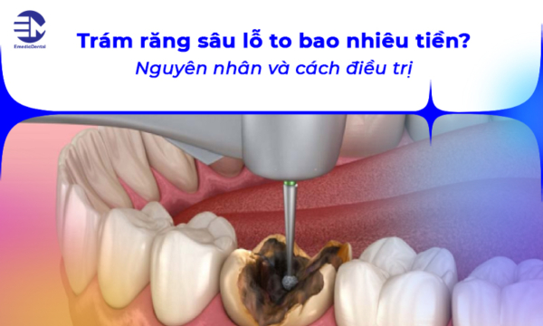 Trám răng sâu lỗ to bao nhiêu tiền? Nguyên nhân và cách điều trị