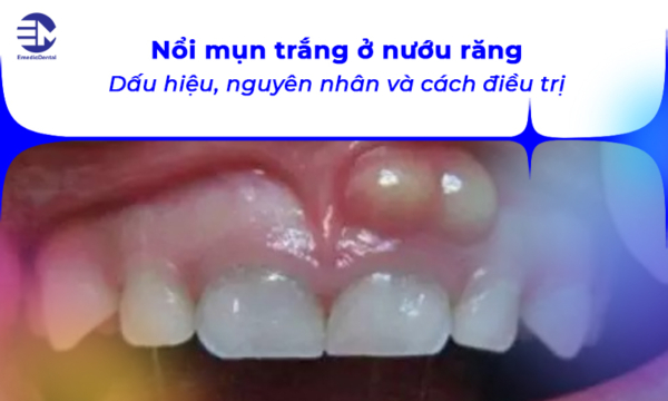 Nổi mụn trắng ở nướu răng: Dấu hiệu, nguyên nhân và cách điều trị