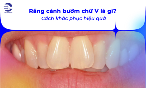 Răng cánh bướm chữ V là gì? Cách khắc phục hiệu quả