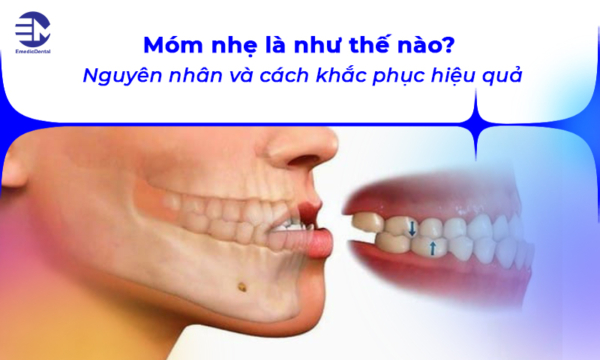 Móm nhẹ là như thế nào? Nguyên nhân và cách khắc phục hiệu quả