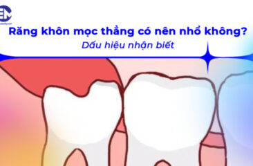 Răng khôn mọc thẳng có nên nhổ không? Dấu hiệu nhận biết