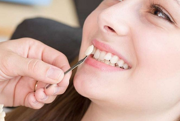 Đắp răng khểnh là gì?