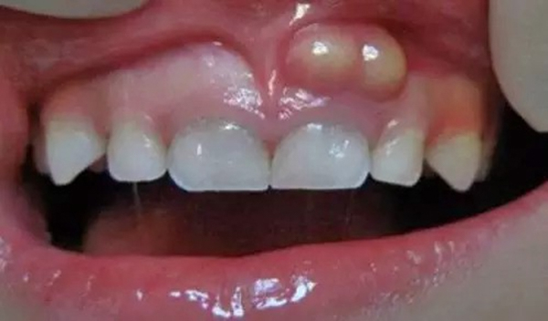 Tình trạng nổi mụn trắng ở nướu răng