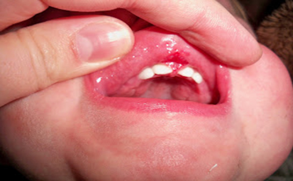 Lợi em bé 4 tháng tuổi lở loét, chảy máu do răng sữa sắp mọc lên.