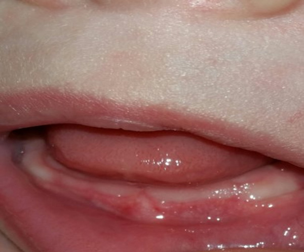 Bé trai 5 tháng tuổi lợi sưng đỏ, có mủ ở vùng răng cửa dưới chuẩn bị mọc.