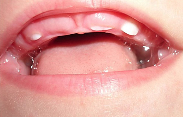 Bé gái 10 tháng tuổi lợi phù nề, viêm nhiễm nghiêm trọng tại vị trí răng nanh đang đâm lên.