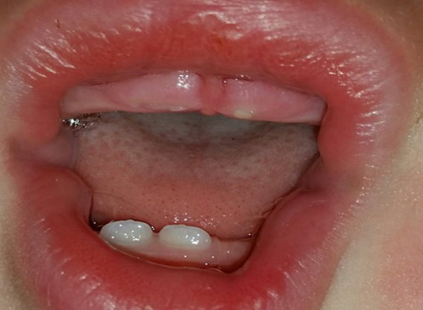Lợi em bé 8 tháng bị tấy đỏ, sưng nề khá rõ ràng ở vùng răng cửa trên sắp mọc ra.
