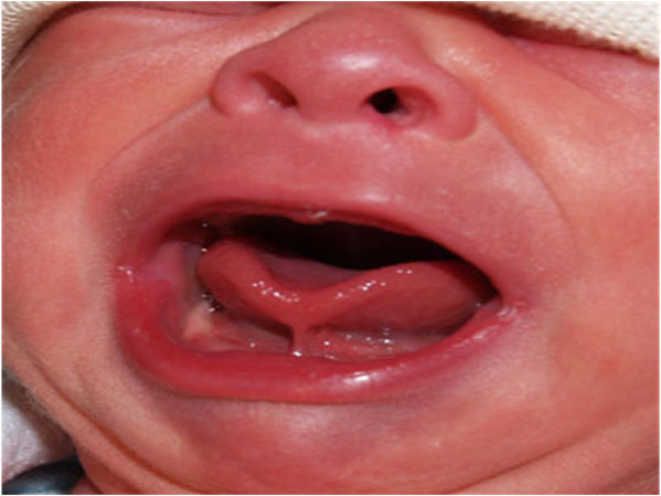 Lợi trẻ sơ sinh sưng to, phồng rộp, có mủ và máu do răng mọc lên gây tổn thương.