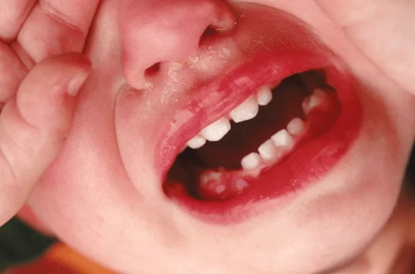 Bé trai 3 tuổi lợi bị viêm nặng, sưng đỏ cả vùng hàm dưới và hàm trên.
