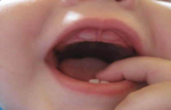 Em bé 8 tháng lợi sưng lên khi răng cửa chuẩn bị mọc.