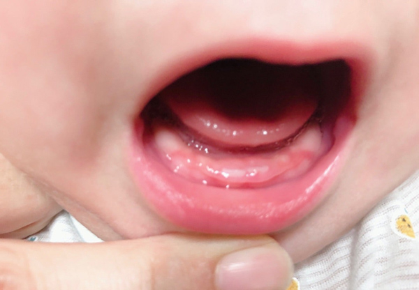 Sau khi lợi bé bắt đầu sưng đỏ khoảng 3-5 ngày là bé sẽ bắt đầu mọc răng