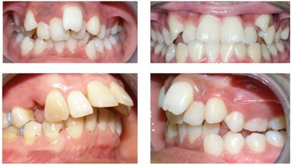 Một số trường hợp răng hô, răng vẩu nặng