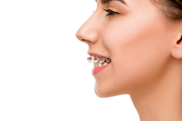 Một số trường hợp sẽ niềng răng hàm dưới và hàm trên ở 2 thời điểm khác nhau