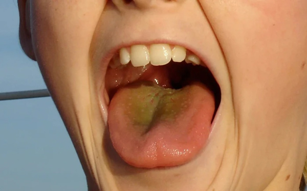 Lưỡi màu vàng thường đi kèm với nhiều triệu chứng khác