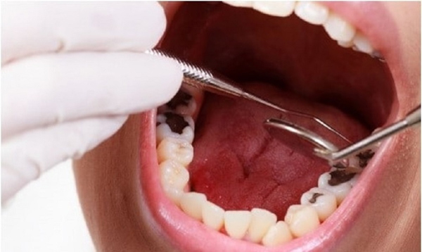 Tình trạng răng sâu lỗ to