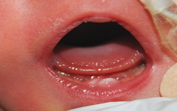 Lợi trẻ nhỏ bị viêm đỏ, sưng nề và nổi cục cứng tại vị trí răng sữa đang đâm lên.
