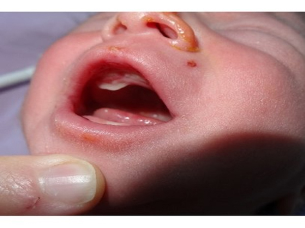 Bé trai sơ sinh lợi phù nề, viêm nặng ở vùng răng cửa trên sắp mọc ra.