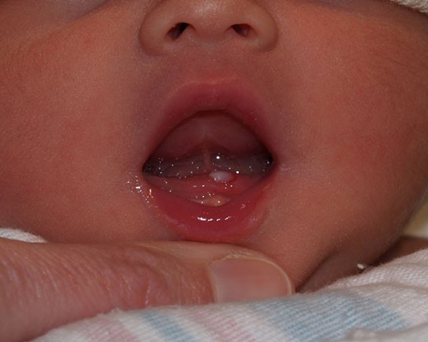 Em bé 5 tháng tuổi lợi bị sưng tấy, viêm đỏ rõ ràng khi răng cửa dưới chuẩn bị mọc lên.