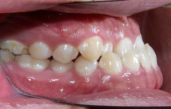 Răng hàm dưới bị lệch lạc, hô hay móm méo