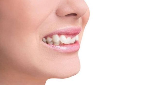 Móm răng nhẹ tuy ít gây đau đớn về mặt sinh lý nhưng lại có tác động rất lớn đến thẩm mỹ