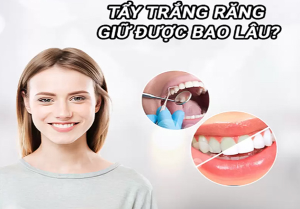 Hiệu quả tẩy trắng răng sẽ được duy trì trong khoảng 6 đến 12 tháng