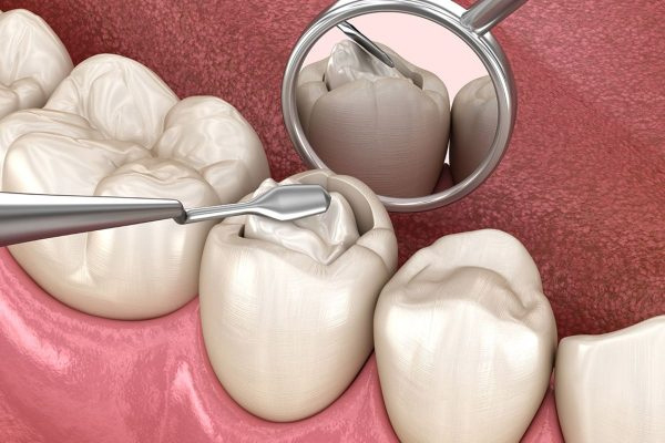 Sau khi đã trám bít ống tủy, bác sĩ có thể tiến hành phục hình lại răng để khôi phục bề mặt răng về trạng thái ban đầu