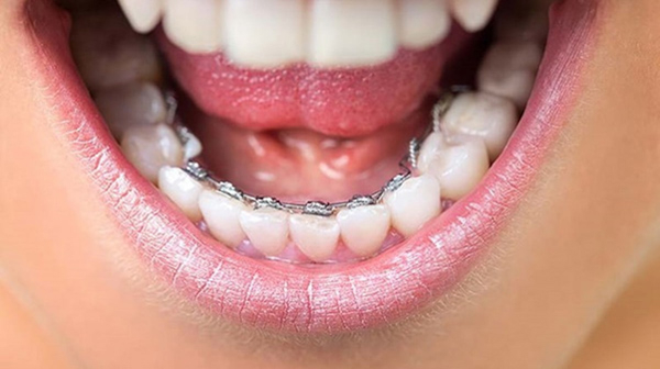 Niềng răng hàm dưới thường có chi phí cao hơn do tính phức tạp và thời gian điều trị lâu hơn