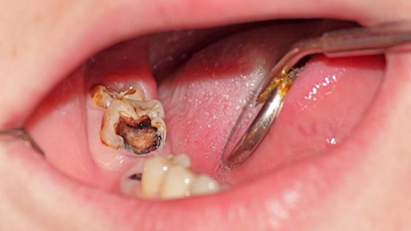 Lỗ sâu răng to có trám được không hay phải nhổ?