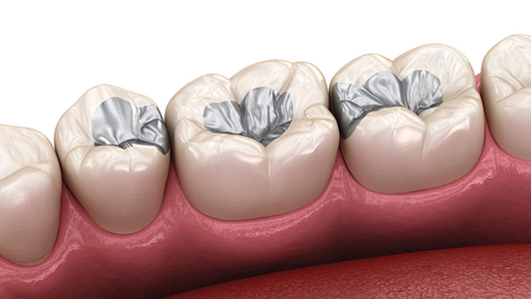 Trám răng bằng vật liệu hàn răng Amalgam