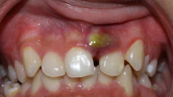 Áp xe răng  có thể xảy ra nếu không xử lý kịp thời các mụn trắng ở nướu răng