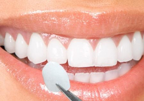 Phương pháp bọc răng sứ