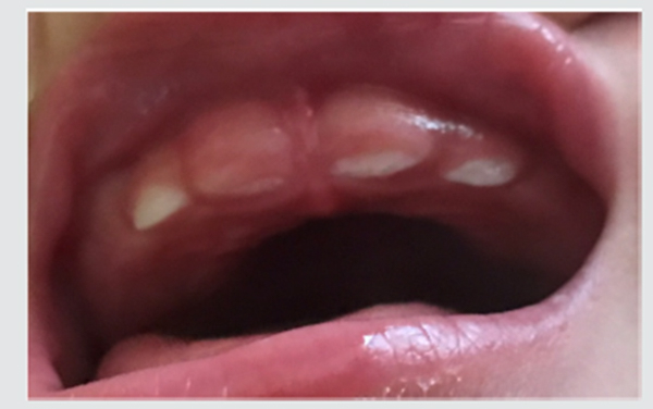 Lợi em bé 8 tháng tuổi sưng tấy đỏ ở vùng răng nanh báo hiệu răng sắp mọc.