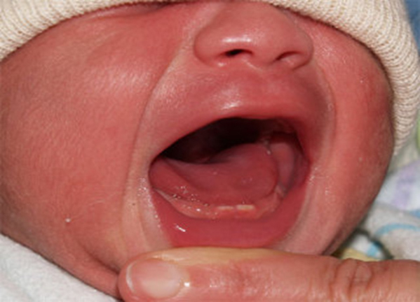 Bé sơ sinh lợi bị viêm nhiễm chứng tỏ răng đang đâm ra.