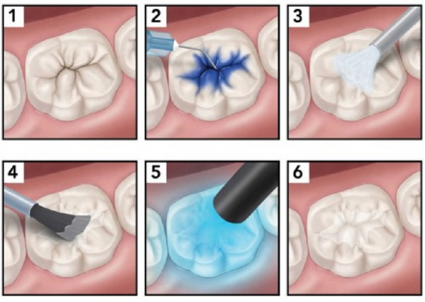 Quy trình trám răng sâu lỗ to đảm bảo an toàn và hiệu quả