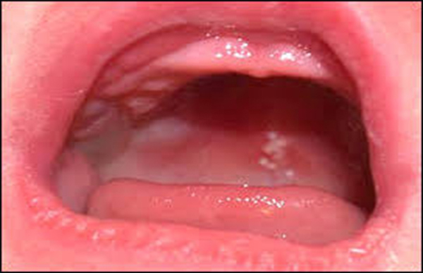 Lợi trẻ nhỏ phình to, đỏ tấy do quá trình mọc răng gây kích ứng.