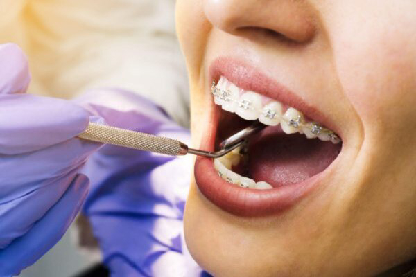 Niềng răng hỏng phải khắc phục như thế nào?