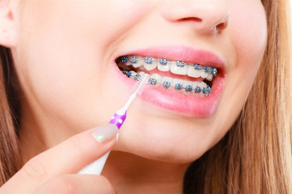 Những điều cần lưu ý chăm sóc răng miệng khi niềng răng bị hỏng