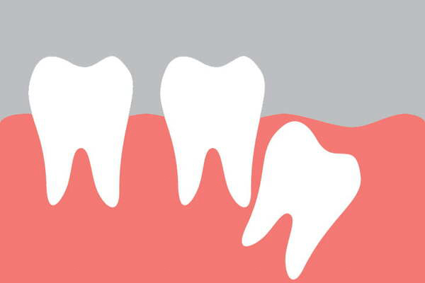 Răng khôn mọc thẳng có nên nhổ không?