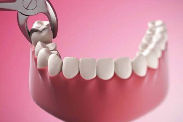 Quy trình nhổ răng khôn mọc thẳng diễn ra như thế nào?