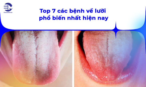 Top 7 các bệnh về lưỡi phổ biến nhất hiện nay