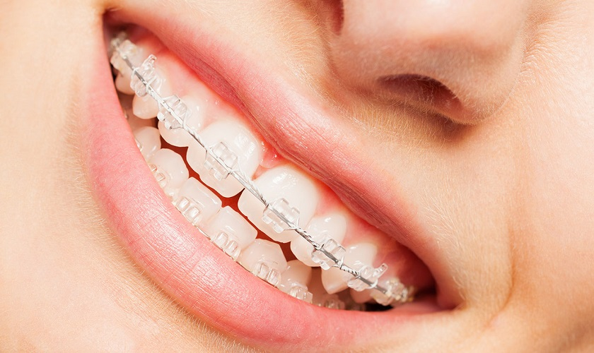 Niềng răng mắc cài sứ đang trở nên phổ biến do ưu điểm tính thẩm mỹ cao