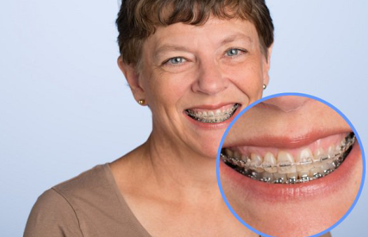 Quy trình niềng răng cho người lớn tuổi